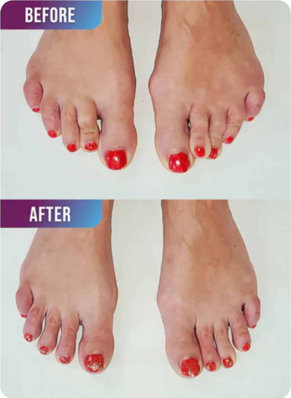 Toe Spreaders - Image 3